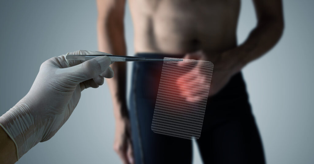 Surgical mesh for hernia condition